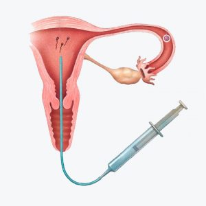 Que es la inseminacion artificial
