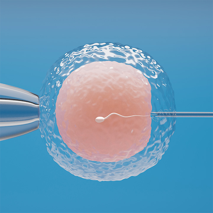 Inyección Intracitoplasmática ICSI