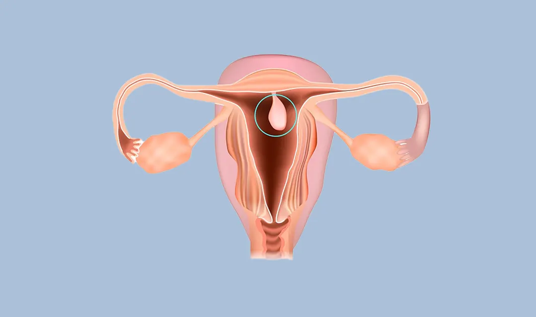 Pólipos uterinos