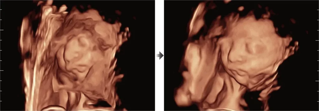 Ultrasonido Inteligente para mujeres embarazadas y análisis fetal