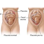 Placenta Previa