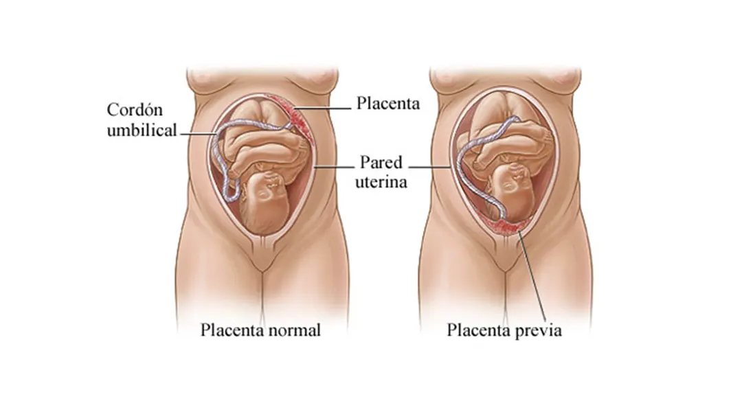 Placenta Previa